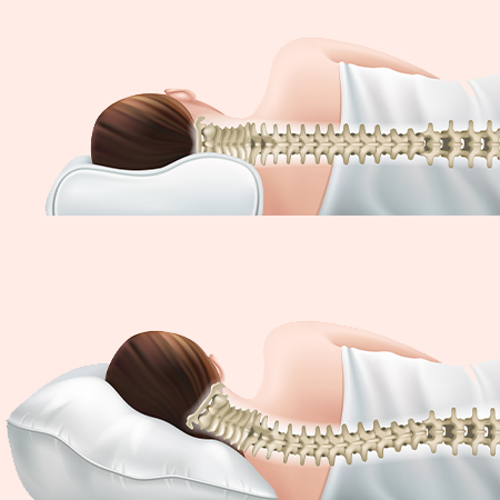 척추측만증 이미지