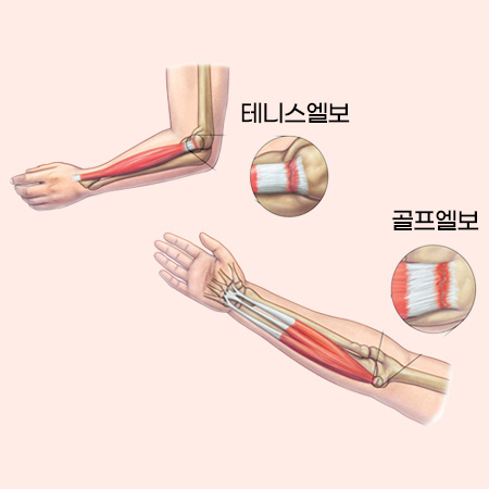 골프·테니스 엘보우 이미지